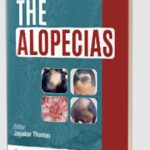 The Alopecias by Jayakar Thomas PDF Free Download