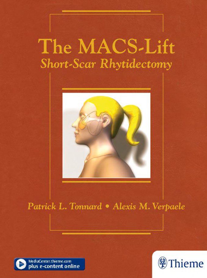 The MACS-Lift: Short-Scar Rhytidectomy PDF Free Download