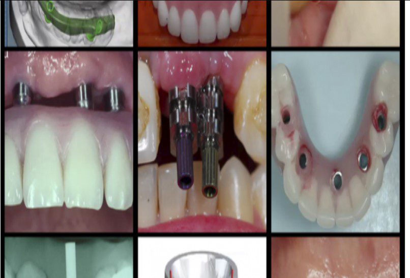 gIDEdental A-Z in Restorative Implant Dentistry Videos Free Download