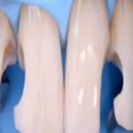 gIDEdental Direct and Indirect Adhesive Restorations 2020 Videos Free Download