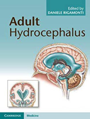Adult Hydrocephalus PDF Free Download