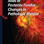 Atlas of Posterior Fundus Changes in Pathologic Myopia PDF Free Download