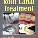 Download Step by Step Root Canal Treatment PDF Free