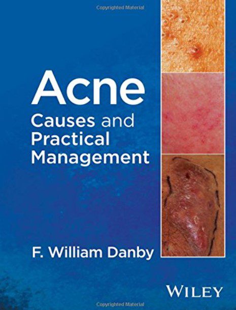 Acne Causes and practical management By F. William Danby PDF Free Download